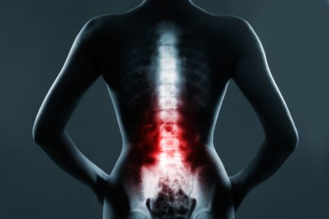 Landmark Stem Cell Clinical Trial Testing Escalating Doses of AST-OPC1 (Oligodendrocyte Progenitors) Bolesti Chrbta, Causes Of Back Pain, Human Spine, Spinal Nerve, Energy Therapy, La Pollution, Spinal Cord, Central Nervous System, Nerve Pain