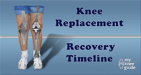 What To Wear After Knee Replacement, Recovering From Knee Replacement Surgery, Total Knee Surgery, Knee Replacement Humor, Exercise For Bad Knees, Full Knee Replacement, Knee Replacement Surgery Recovery, Tummy Tucks Recovery, Healthy Knees