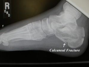 Calcaneal (Calcaneus) Fracture | footEducation Calcaneus Fracture, Bone Fracture, The Goal, Surgery, Bones