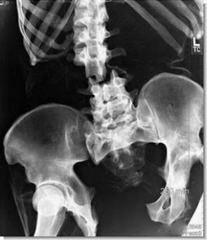 Fracture spine because the fracture of the heel Xray Humor, Radiology Humor, Rad Tech Week, Radiologic Technology, X-ray Images, Radiology Tech, Surgical Technologist, Radiology Technologist, Accident Injury