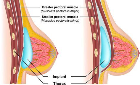 Breast implant in Chandigarh Saline Implants, Medical Vector, Pectoral Muscles, Bath And Body Works Perfume, Breast Augmentation, Silicone Gel, Plastic Surgeon, Chandigarh, Womens Health