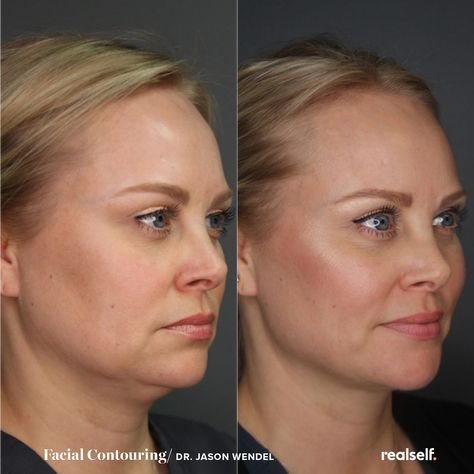 Double Chin Fillers Before And After, Weak Chin Profile, Double Chin Injection, Jaw Exercises Before And After, Eliminate Double Chin, Chin Lift Before And After, Double Chin Removal Surgery, Chin Injection Before And After, Double Chin Lipo Before And After