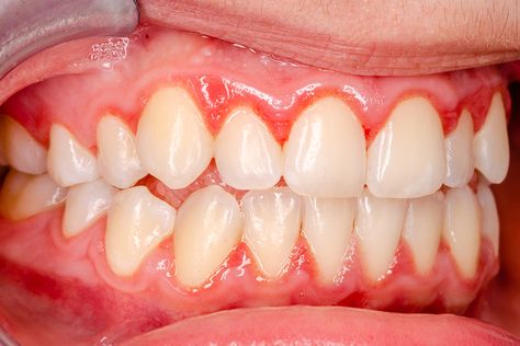 Desquamative gingivitis Flesh Eating Bacteria, Gum Surgery, Laser Dentistry, Periodontal Disease, Receding Gums, Gum Health, Healthy Teeth, Oral Hygiene, Dental Health