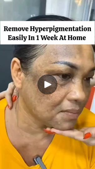 8.7K views · 160 reactions | Best Home Remedy To Remove Hyperpigmentation At Home  . . . . . . . . #diyskincare #skincare #beauty #diybeauty #diy #naturalskincare #skincareroutine #skincaretips #beautytips #skincareproducts #diys #organicskincare #glowingskin #diyideas #diybeautytips #acne #diyskincarerecipes #organicbeauty #diyblogger #diyfun #softskin #healthyskin #nontoxicskincare #diycrafts #selfcare #pimples #blackheads #diyproject #diyfashion #healthtips | Organic Beauty | ZB · Kareja Ho 2 Remove Hyperpigmentation, Removing Hyperpigmentation, Nontoxic Skincare, Diy Skin Care Recipes, Kindergarten Crafts, Diy Skincare, Remove Acne, Diy Beauty Hacks, Organic Beauty