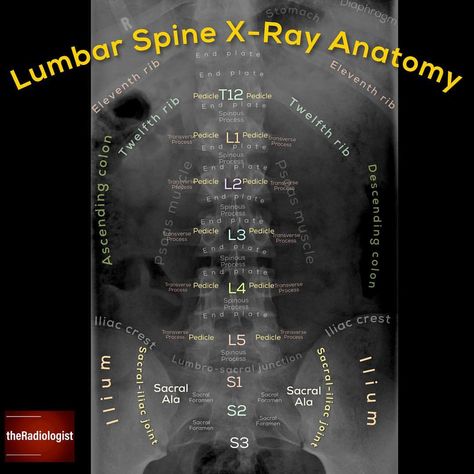 Read on to learn a system to review an AP lumbar spine X-Ray!⁣ ⁣ ⁣ LUMBAR SPINE AP X-RAY⁣ 👨🏽‍💻As always this film needs to be reviewed in… Lumbar Spine Xray Anatomy, Thoracic Spine Xray, Lumbar Spine Anatomy, Lumbar Spine Xray, X Ray Anatomy, Radiology Schools, Medical Radiography, Medical Terminology Study, Radiologic Technology