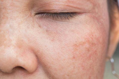 4 Easy Ways To Reduce Sun Damage Now Brown Age Spots, Skin Care Specialist, Treating Hyperpigmentation, Natural Face Mask, Freckle Face, Sun Damaged Skin, Chemical Peel, Skin Discoloration, Sun Damage