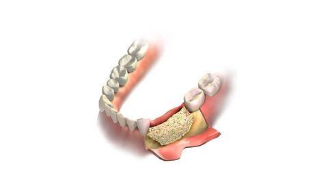 Suffering from bone loss but want to get your Implants for a beautiful smile transformation? Then visit our office, in Cincinnati, OH for Bone Grafting! Bone Grafting Teeth, Smile Transformation, Bone Grafting, Teeth Implants, Bone Loss, Dental Implants, Beautiful Smile, Dental Care, Cincinnati