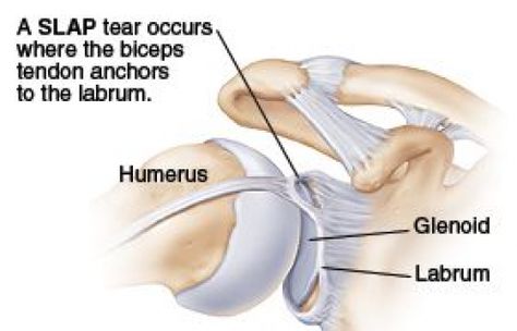 Shoulder Anatomy, Shoulder Dislocation, Shoulder Rehab, Shoulder Problem, Shoulder Impingement, Shoulder Surgery, Muscle Anatomy, Orthopedic Surgery, Shoulder Injuries