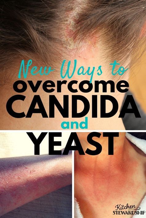 New Ways to Overcome Candida and Yeast - fermented foods to eat, will killing it with herbs help, and what foods to avoid - via Body Ecology Diet Candida Cleanse Diet, Body Ecology Diet, Candida Symptoms, Yeast Overgrowth, Candida Diet Recipes, Candida Cleanse, Candida Yeast, Candida Overgrowth, Candida Albicans