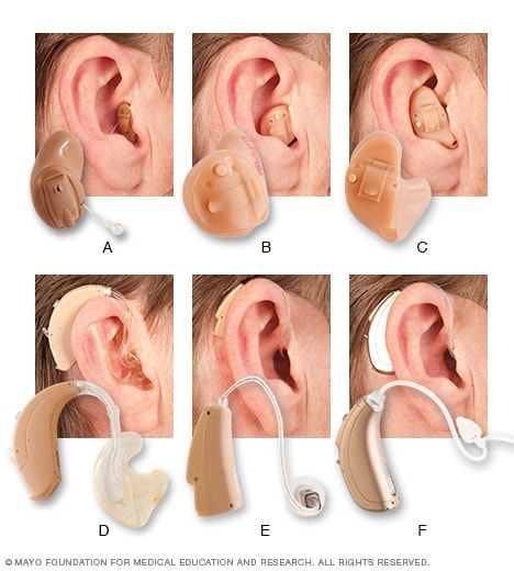 Swimmers Ear Remedy, Throat Anatomy, Audiology Student, Swimmers Ear, Portugal Art, Auditory Processing Disorder, Speech And Hearing, Hearing Health, Cochlear Implant