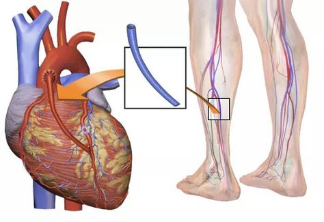 Thoracic CABG surgery Open Heart Surgery, Bypass Surgery, Nursing School Notes, Coronary Arteries, Heart Surgery, Medical Tourism, Heart Health, Travel Posters, Surgery