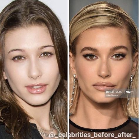 Hailey Bieber Before And After Surgery, Blephoraplasty Surgery, Heavy Upper Lip, Blephoraplasty Before And After, Makeup Inspo Blonde, Jaw Reduction Surgery, V Line Surgery, Plastic Surgery Fail, Rhinoplasty Nose Jobs