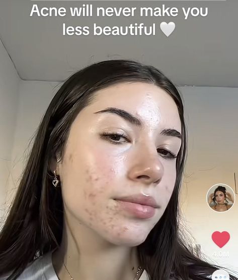 Beautiful Girls With Acne, Embracing Acne, Acne Makeup Looks, Models With Acne, Acne Confidence, Acne Is Beautiful, Pretty People With Acne, Girls With Acne, Acne Pretty