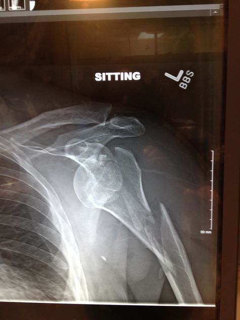 #Motocross injury, shoulder, and humerus shattered and dislocated Dislocated Left Shoulder, Motocross, Health, Quick Saves