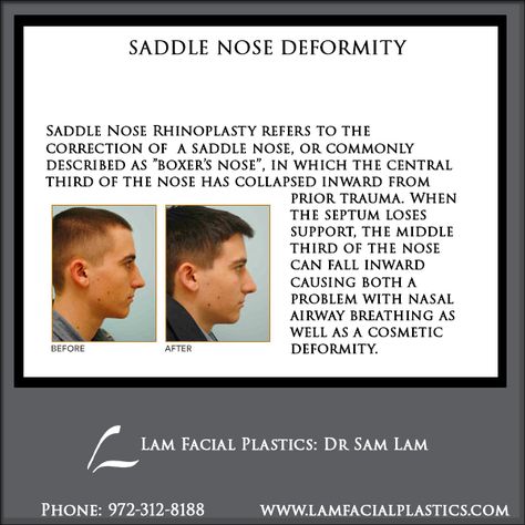 Saddle Nose Rhinoplasty refers to the correction of  a saddle nose, or commonly described as "boxer's nose", in which the central third of the nose has collapsed inward from prior trauma. @LamFacialPlastics #LamFacialPlastics #DrSamLam #PlasticSurgery #DallasPlasticSurgeon #SaddleNoseDeformity #SaddleNoseRhinoplasty Nose Rhinoplasty, Rhinoplasty Nose Jobs, Rhinoplasty Surgery, Nose Surgery, Scientific Articles, Facial Plastic, Nose Job, Stone Cold, Plastic Surgeon