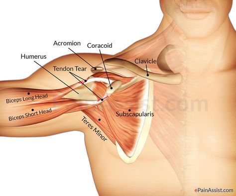 Shoulder Anatomy, Shoulder Rehab, Rotator Cuff Tear, Ligament Tear, Ligaments And Tendons, Muscle Atrophy, Human Body Anatomy, Medical Anatomy, Shoulder Muscles