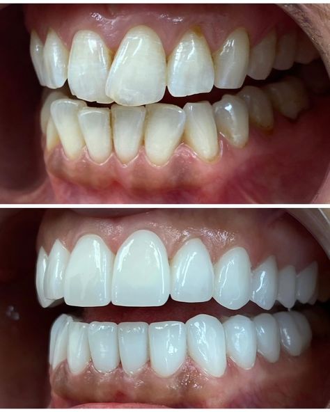 Jagged mess to straight perfection🔥 Love seeing how easy it is for someone to smile after a transformation! Truly love what I do #dentistry #instagood #reel #happy #transformation Quick Saves