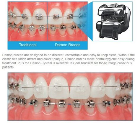 Braces Care, Damon Braces, Wheaton Illinois, David Allen, Brace Face, Teeth Braces, David J, All About, The Smile