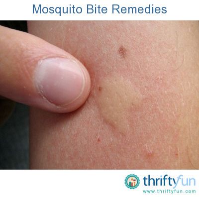 Stopping the itch and irritation of mosquito bites isn't always easy. This guide contains mosquito bite remedies. Remedies For Mosquito Bites, Bug Bites Remedies, Mosquito Bites, Mosquito Bite, Bug Repellent, Bug Bites, Homemade Remedies, Diy Health, Health And Beauty Tips