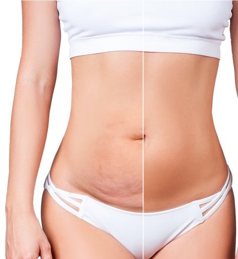 Beauty Surgery, Tummy Tucks Recovery, Flatter Stomach, Excess Skin, Compression Garment, Tummy Tucks, Loose Skin, Sagging Skin, Plastic Surgeon