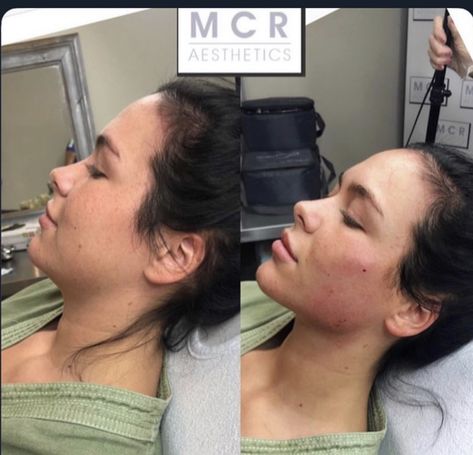 Face Plastic Surgery, Nose Fillers, Chin Filler, Rhinoplasty Nose Jobs, Lips Inspiration, Face Fillers, Botox Lips, Cheek Fillers, Facial Surgery