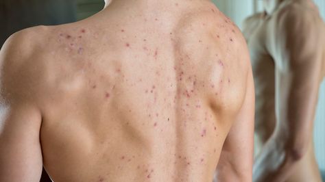 Cystic back acne: Causes and how to treat it What Causes Pimples, Back Acne Remedies, Back Acne, Greasy Skin, Acne Vulgaris, Severe Acne, Sweat Gland, Body Acne, Acne Problem