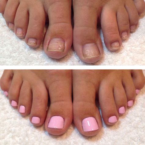 Manicure Before And After, Pedicure Before And After, Pedicure Tradicional, School Portfolio, Toes Nails, Summer Pins, Oil Field, Acrylic Toe Nails, Acrylic Toes