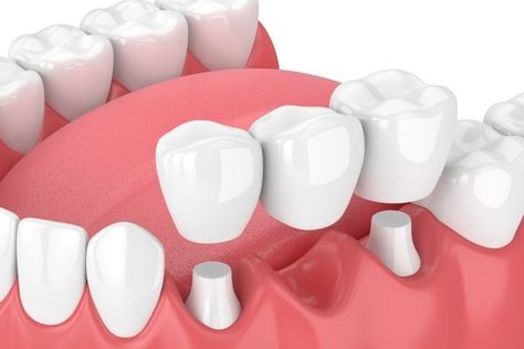 How To Care For Your Dental Bridge - Dental Studio Dental Bridge Cost, Dental Pictures, Dental Implant Procedure, Kedokteran Gigi, Tooth Replacement, Restorative Dentistry, Teeth Implants, Dental Bridge, Dental Crowns