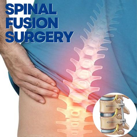 spinal fusion surgery is a significant medical intervention that offers hope and relief to individuals suffering from certain spinal conditions and injuries. #spinalfusionsurgery #spinalsurgery #successfulsurgery #spinesurgery Spinal Fusion Surgery, Spinal Fusion, Ray Of Hope, Spinal Surgery, Bulging Disc, Disk Herniation, Neck Surgery, Spine Surgery, Leg Pain