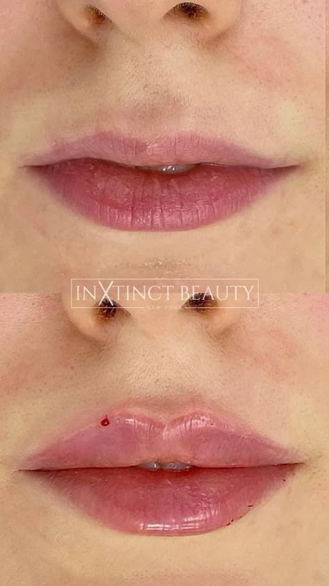 https://pin.it/7ueO5YwJy Lip Filler Inspo Heart Shape, Keyhole Lip Fillers, Russian Lips Filler Before And After, Russian Lips Filler, 1ml Lip Filler, Cupids Bow Lips, Russian Lips, Dermal Fillers Lips, Cosmetic Injections