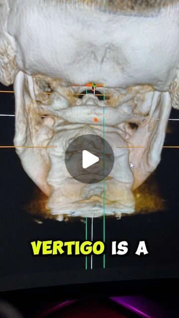 Lavender Family Chiropractic on Instagram: "Has anyone ever explained vertigo to you this way? 🤔 Let us know below 👇 #uccnearme #vertigo" Vertigo Relief Remedies, Epley Maneuver, Vertigo Causes, Vertigo Exercises, Vertigo Relief, Vertigo Remedies, Family Chiropractic, Spine Health, Relieve Back Pain