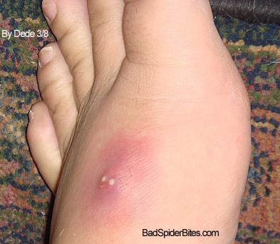 Picture of spider bite on top of foot Helpful Things, Health Heal, Home Health Remedies, Natural Health Remedies, Alternative Health, Natural Home Remedies, Back To Nature, Health Info, Health And Beauty Tips