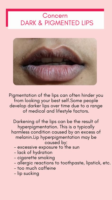 Smoker Girl, Remedies For Dark Lips, Aloe Vera For Sunburn, Lip Treatments, Dark Lip, Lipstick For Dark Skin, Natural Remedies For Migraines, Pimples On Face, Natural Skin Care Remedies