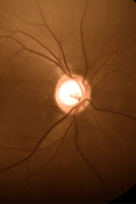 large cup-to-disc-ratio Optic Nerve Damage, Ophthalmology Background, Opthalmic Technician, Eye Pressure, Eyesight Problems, Opthamologist Eye Doctor, Optic Nerve, Eye Health, Nerve