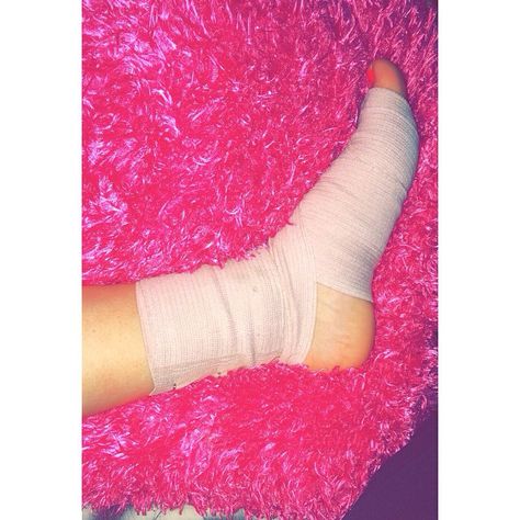 Sprained my foot... Not fun Leg Plaster Snapchat, Leg Fracture Snap, Leg Injury Snapchat Streaks, Broken Leg Snapchat Story, Leg Fracture Snapchat, Sprained Ankle Snapchat, Leg Injury Fake Story, Broke Leg Snapchat, Fracture Photo