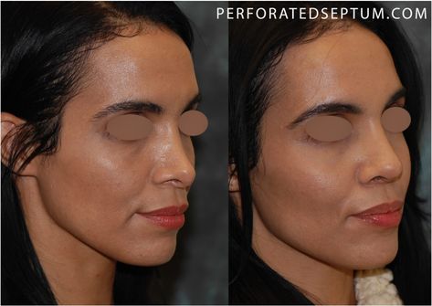 saddle nose deformity Rhinoplasty Recovery, Nasal Obstruction, Nasal Septum, Neck Surgery, Facial Plastic Surgery, Facial Plastic, Nose Job, Success Rate, The Flame