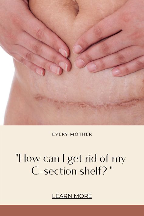 Scar Tissue Massage, C Section Belly, After C Section Workout, Post C Section, C Section Workout, C Section Scars, Diastasis Recti Exercises, Fitness Influencer, C Section Recovery