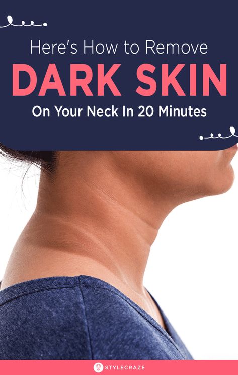 How To Remove Dry And Dark Skin On Your Neck In 20 Minutes: The darkening of the skin on the neck could be due to a lot of reasons. Sun exposure could be one of the main reasons, but it could also be due to a specific health concern such as insulin resistance. For those of us who have just been negligent with sunscreens, here are some easy remedies to gradually lighten those patches on your neck. #Remedies #HomeRemedies #DarkNeck #SkinCare Dark Skin Around Neck, Dark Neck Remedies, Skin Lightening Diy, Dark Neck, Blind Pimple, Pimples Under The Skin, Skin Darkening, Tan Removal, Skin Shine