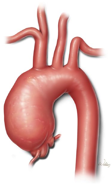 ascending aortic aneurysm | . This aneurysm involves the ascending aorta and transverse aortic ... Aortic Arch, Subclavian Artery, Brain Surgeon, Medical Posters, Medical Photos, Blood Sugar Diet, Healthy Diet Tips, Medical Anatomy, Daily Health Tips