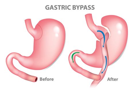 Roux-en-Y gastric bypass (RYGB) is a type of bariatric surgery that is done laparoscopically or robotically. Bariatric Surgeon, Sleeve Gastrectomy, Laparoscopic Surgery, Bypass Surgery, Gastric Bypass, Patient Experience, Digestion Problems, Surgery, Medical