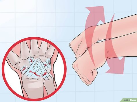 Wrist Fracture, Wrist Sprain, Avulsion Fracture, Sprained Wrist, Hairline Fracture, Wrist Injury, Bone Fracture, Cleveland Clinic, Back Pain Exercises