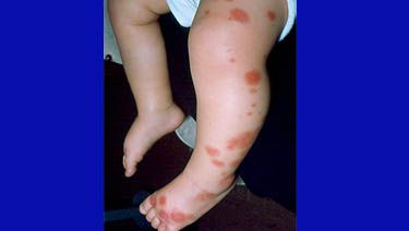 Henoch-Schonlein Purpura - HealthyChildren.org Henoch Schonlein Purpura, Kidney Biopsy, Strep Throat, Kidney Damage, Respiratory Infection, Abdominal Pain, Blood Test, Signs And Symptoms, Blood Vessels