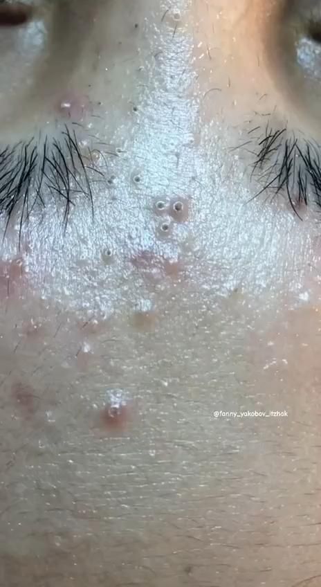 credit@fanny_vakobov Face Mask For Blackheads, Zits Popping, Blackhead Mask, Acne Help, Facial Brush, Magnesium Deficiency, Clear Skin Tips, Facial Brushes, Natural Cold Remedies