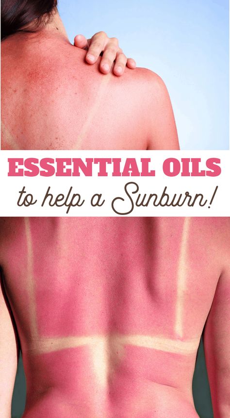 Best Sunburn Remedy, Sun Burn Remedy, Sunburn Essential Oils, Doterra Sunburn, What Helps With Sunburns, Oils For Sunburn Relief, Doterra Sunburn Relief, Sunburn Relief Essential Oils, Sunburn On Face