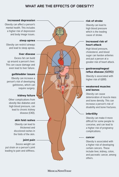 Obesity Help, Obesity Awareness, Obese Workout, Health Facts Food, Liv Pure, Obese People, Weight Problems, Reduce Body Fat, Diet Exercise