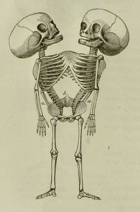 Sketch of conjoined twins Conjoined Twins Aesthetic, Conjoined Twins Tattoo, Conjoined Twins Drawing, Scientific Sketches, Conjoined Twins Art, Conjoined Twins Oc, Conjoined Skeleton, Conjoined Twins, Vulture Culture