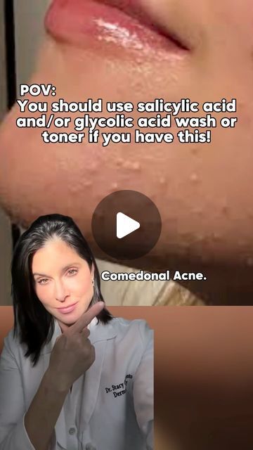 Stacy Chimento Capote on Instagram: "If you have blackheads and white heads, consider cleansers and or toners with glycolic or salicylic acid. These gentle acids ( BHA and AHA ) lightly exfoliate the skin and improve the texture and tone of the skin .   What’s the difference?  AHAs such as glycolic, lactic, Mandelic, tartaric and citric acids are made from sugary fruits. They help peel away the surface of your skin so that new, more evenly pigmented skin cells may generate and take their place. After use, you’ll likely notice that your skin is smoother to the touch.  BHAs are oil-soluble. The most common AHA is salicylic acid. Unlike AHAs, BHAs can get deeper into the pores to remove dead skin cells and excess sebum. This is more of my go to for acne 👍" How To Use Salicylic Acid, Salysalic Acid, White Heads Removal, Salicylic Acid Benefits, Comedonal Acne, Pigmented Skin, Clear Skin Routine, Skin Bumps, Face Care Routine