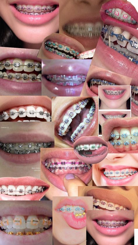 Cute Braces Colors, Pretty Teeth, Braces Tips, Grillz Teeth, Getting Braces, Cute Braces, Diamond Teeth, Brace Face, Braces Colors