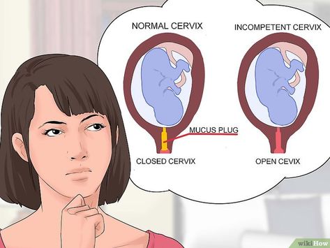 How to Prevent Incompetent Cervix: 11 Steps (with Pictures) Cervical Effacement, Mucus Plug, Pregnant People, Premature Birth, Pulmonology, Obstetrics And Gynaecology, Pregnancy Symptoms, School Of Medicine