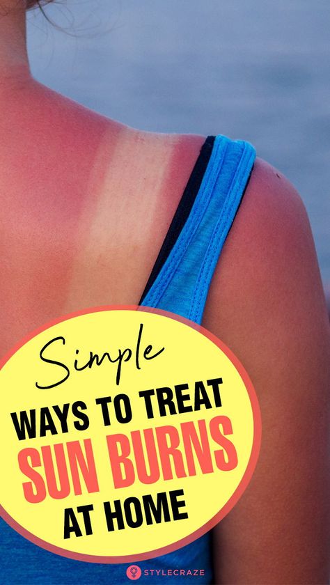 Home Remedy For Sunburn, Natural Remedies For Warts, Remedies For Sunburn, Home Remedies For Sunburn, Get Rid Of Sunburn, Natural Wart Remedies, Sunscreen Tips, Sunburn Peeling, Bad Sunburn